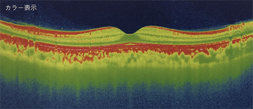 東高円寺眼科のOCT（光干渉断層計）黄斑疾患の例1