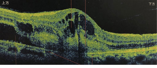 東高円寺眼科のOCT（光干渉断層計）黄斑疾患の例2