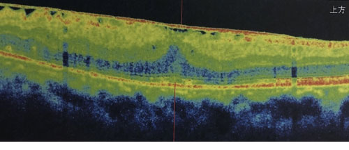 東高円寺眼科のOCT（光干渉断層計）黄斑疾患の例3
